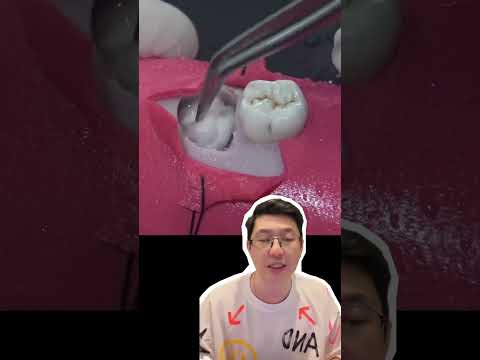 EP.2 | ผ่าฟันคุดอย่างไรให้ไม่เจ็บ ? 🦷🩸#หมอโชค #รากฟันเทียม #คลายปัญหารากเทียมกับหมอโชค