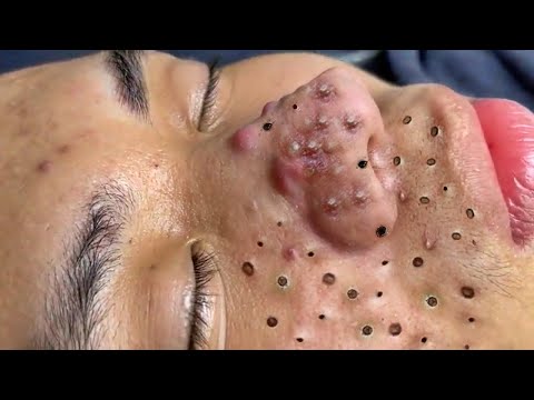 Blackhead Removal With Today Spa #2439