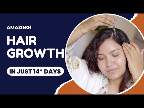 This hair growth serum and tips stopped my hair fall and helped me grow new hair in just 45 days