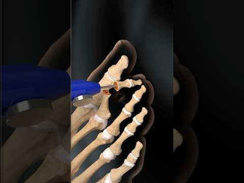 RetroFusion Screw: Innovative Solution for Joint Arthrodesis! video credit: @WhatsNewinOrthopedics