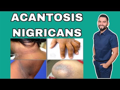 ACANTOSIS NIGRICANS / ACANTOSIS PIGMENTARIA / TENGO EL CUELLO Y LAS AXILAS NEGRAS | DR. DAVID CAMPOS