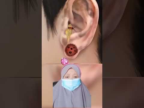 Asmr mulut berbelatung, berulat dan infeksi yang berulat |Mv #shorts