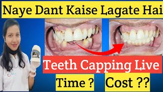 Naye Dant Kaise Lagate Hai |Nakli Dant Ka Kharcha |Teeth Capping Cost |Missing Teeth Replacement