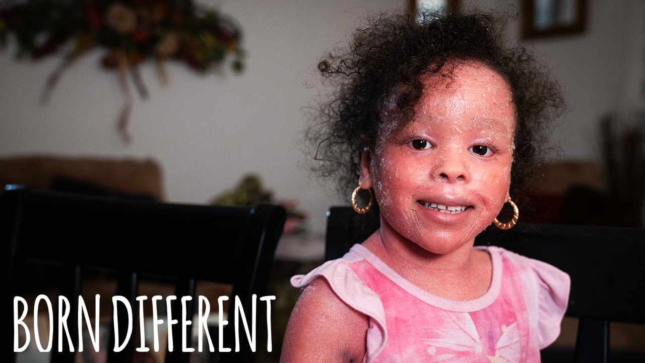 The little girl whose skin grows too fast - born different