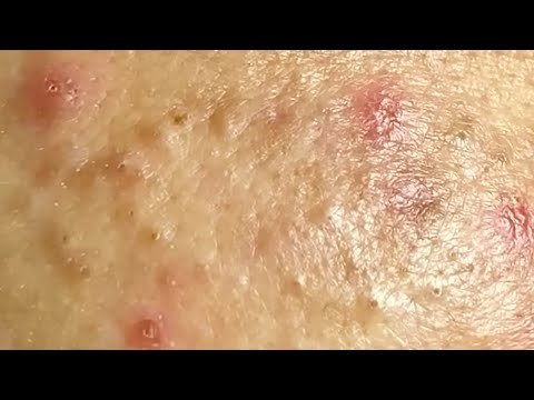 Blackheads & Whiteheads Satisfying Removal @0613