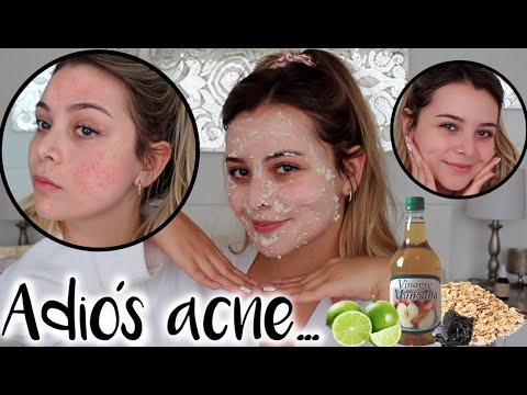 Rutina para eliminar el acné y sus cicatrices! Remedios Naturales - Maqui015 ♥