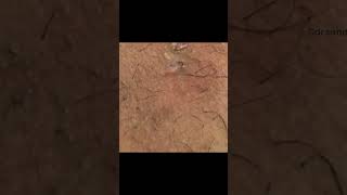 The trickiest DPOW extraction yet