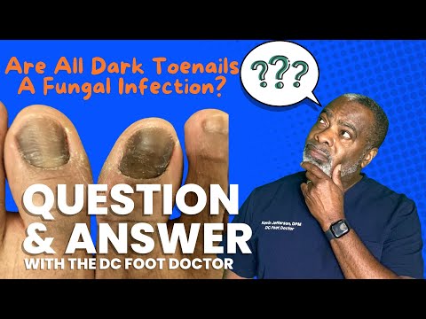 Are All Dark Toenails A Fungal Infection?