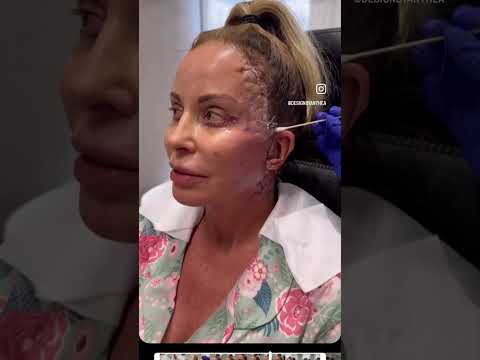 ICONIC FACELIFT Healing & Recovery Process!