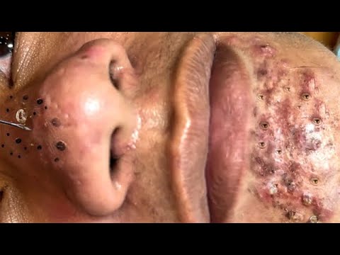 Blackhead Removal With Sac Dep Spa @100074209