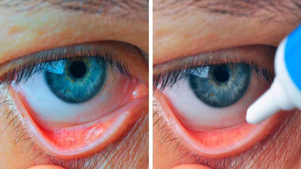 How to Instantly relieve red and Itchy allergy Eyes