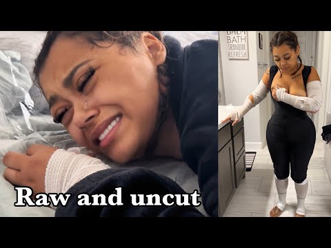 We documented Ally’s Brazilian Butt Lift recovery for 2 Weeks straight... | THE RAW UNCUT TRUTH!!!