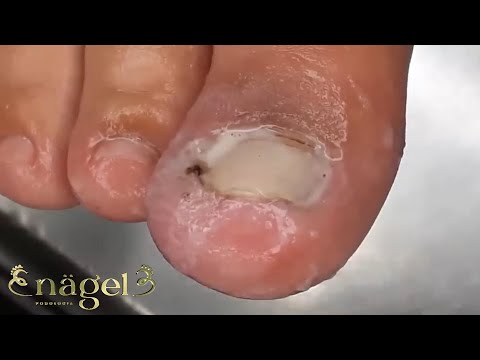 Alívio instantâneo _ procedimento completo (com revisão nos dois pés) #satisfying #nails