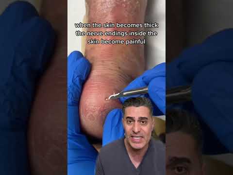 What Is On The Heel Of This Foot? Sweat Gland?