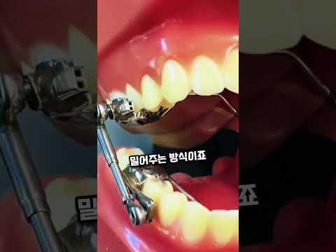 자동차 부품 같은 이 물건의 놀라운 정체