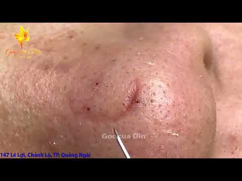 Blackheads & Acne Treatment Date Dec-17-24