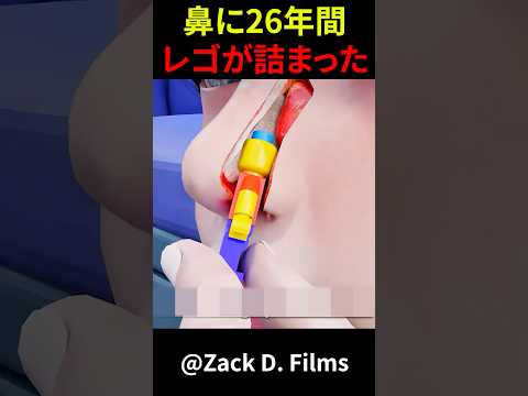鼻に26年間レゴが詰まった　#shorts