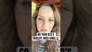 TikToker Goes Viral For “Mexican Face Lift"  #shorts #facelift #plasticsurgery