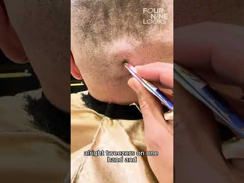 Clutter Of Ingrown Hairs TT/kuaforrekremkacar