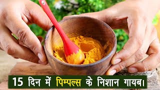 "सिर्फ 15 दिन में हटाएं पिम्पल्स के दाग 😲 | 100% असरदार घरेलू नुस्खा ✨ | Pimples Marks Gone Fast!"