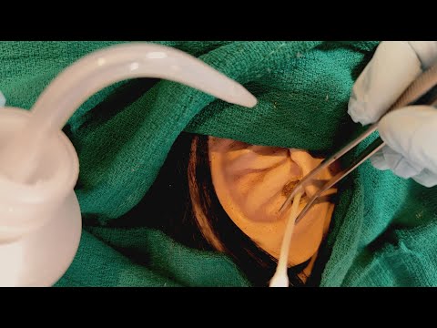 ASMR Removing a Foreign Object from Your Ear | Ear Cleaning | Doctor & Patient POV