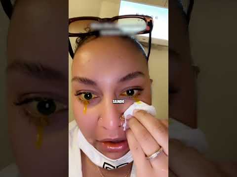 Doença Estranha nos Olhos 😨