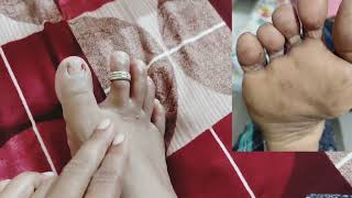 ✌पावसाळ्यात पायाला चिखल्या पडतात त्याची कारणे आणि त्यावर घरगुती उपाय#knoweverything #homeremedy