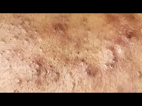 Blackheads & Whiteheads Satisfying Removal @0371