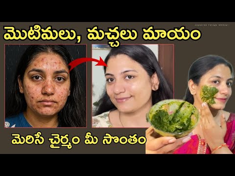 😱 మొటిమలు, మచ్చలు  మాయం చేసి ముఖం మృదువుగా చేసే నాచురల్ PACK