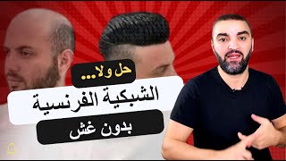 الشبكية الفرنسية لاخفاء الصلع حلم يتحقق ام خدعة تسويقية ؟