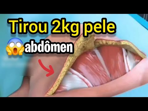 CIRURGIÃO EXPLICA ABDOMINOPLASTIA QUE DEIXA BARRIGA CHAPADA!!!