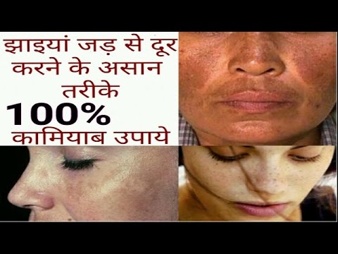 झाइयां जड़ से दूर करने के आसान तरीके ,100 % कामियाब उपाय acne