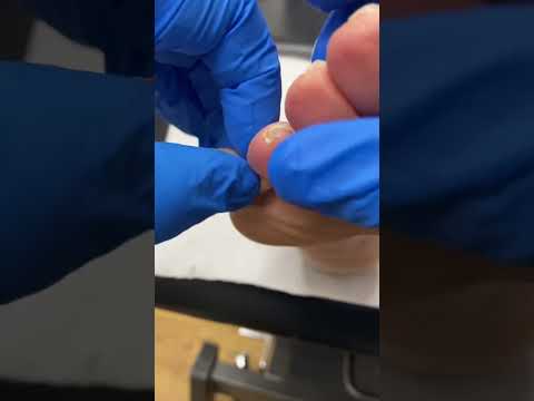 Australian Podiatrist Removes Pinch Callus with Docpods | Effective Callus Removal Techniques