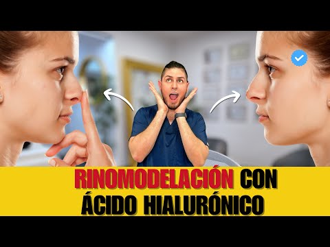 ¿Qué es la RINOMODELACIÓN? | DOCTOR LEMUS Todo lo que necesitas saber