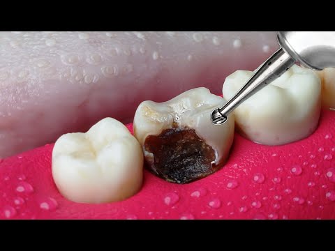 ASMR Restoration! Incredible Tooth Cavity And The Master Dentist