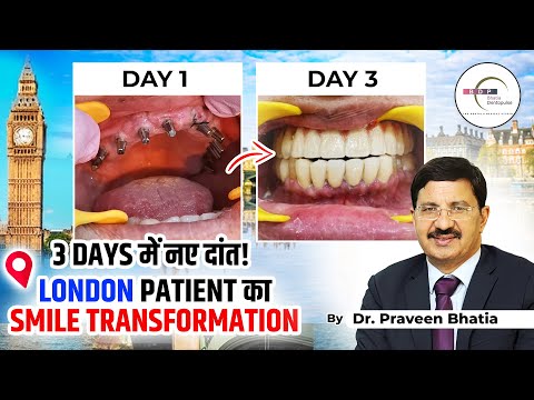 3 Days में नए दांत! London Patient का Smile Transformation | Bhatia Dentopulse: Dr. Praveen Bhatia
