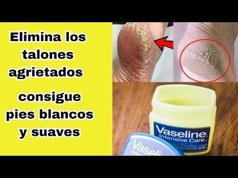 ELIMINA TALONES Agrietados y Resecos/ Pies Blancos y Suaves en  1 Semana