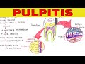 Pulpitis Symptoms and Treatments