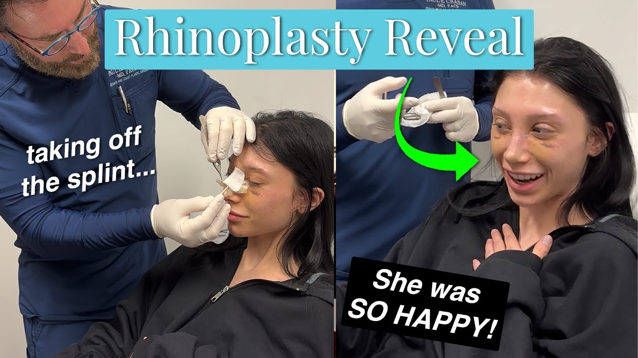 Watch this STUNNING Rhinoplasty Reveal After ONLY Six Days!