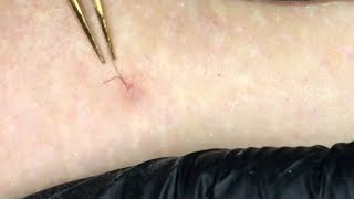 Ingrown Hairs Videos Kansas City Comic Con