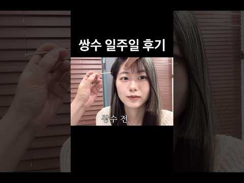 원래 쌍커풀 있는 사람의 쌍수 일주일차 후기