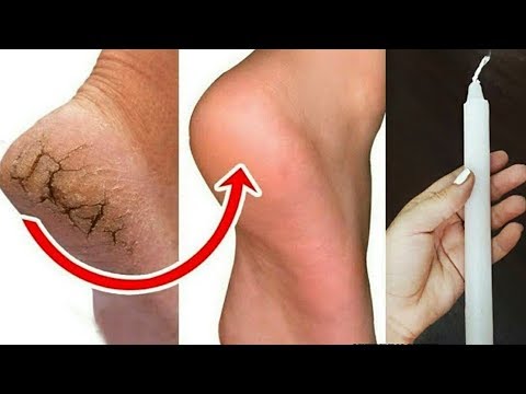 मोमबत्ती का ये तरीका  फटी एड़ियां से छुटकारा पाये !Cracked Heels Remedy,Crack Hel Treatment