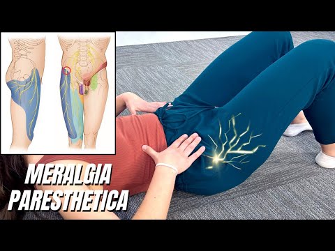 Unlocking Meralgia Paresthetica: Solutions for Nerve Compression Syndrome Revealed!