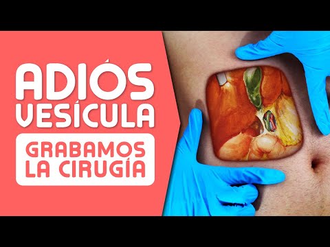 LA VESÍCULA ¿Cuándo es Mejor OPERAR? Síntomas, Cálculos, Pólipos y Cáncer