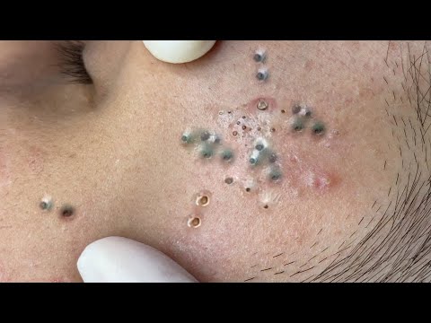 Relax Everyday with Blackheads & Acne Treatment 228