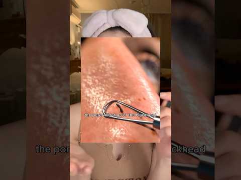 Don't Squeeze Blackheads this tool #chxrryglowy #skincare