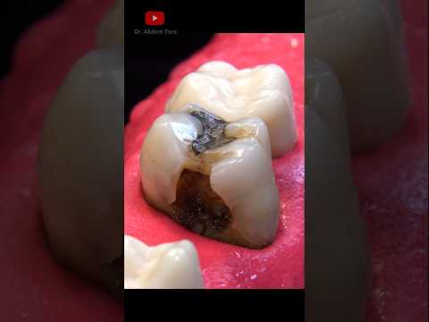 Tratamiento de Conductos y Restauración #satisfying