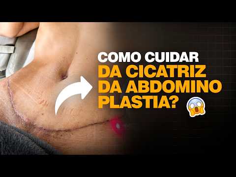 DESCUBRA AGORA: Tudo sobre ABDOMINOPLASTIA com LIPO HD – A TRANSFORMAÇÃO que VOCÊ PRECISA!