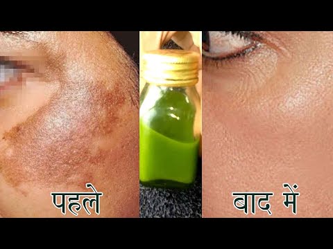 पुरानी झाइयां दाग धब्बे जड़ से खत्म कर देगी यह चीज 100% Working Freckle Pigmentation Solutions