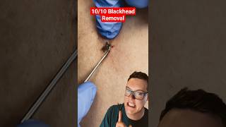 Jaw Dropping BLACKHEAD REMOVAL - The Biggest Blackhead 2026 #shorts